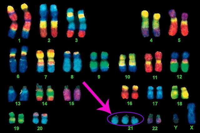 down syndrome chromosone chart